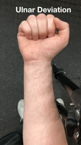 Ulnar Deviation 